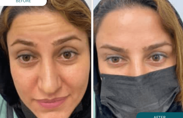 بوتاکس پیشانی