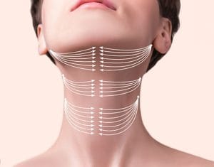 لیفت گردن با نخ