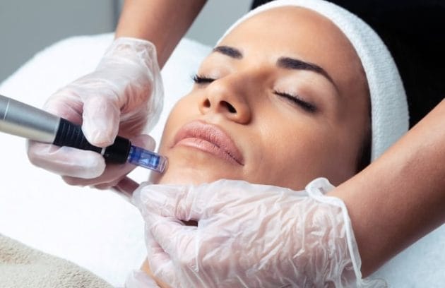 مزوتراپی صورت