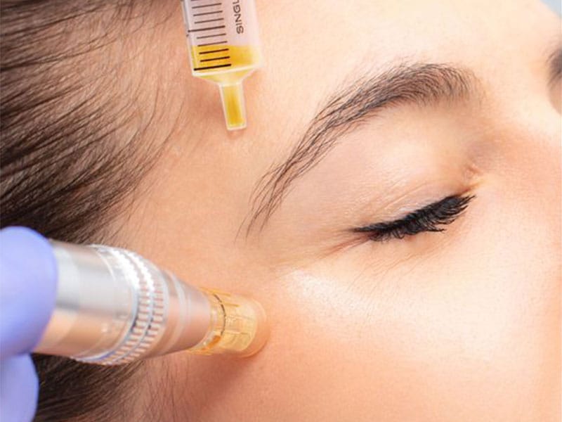 مزونیدلینگ