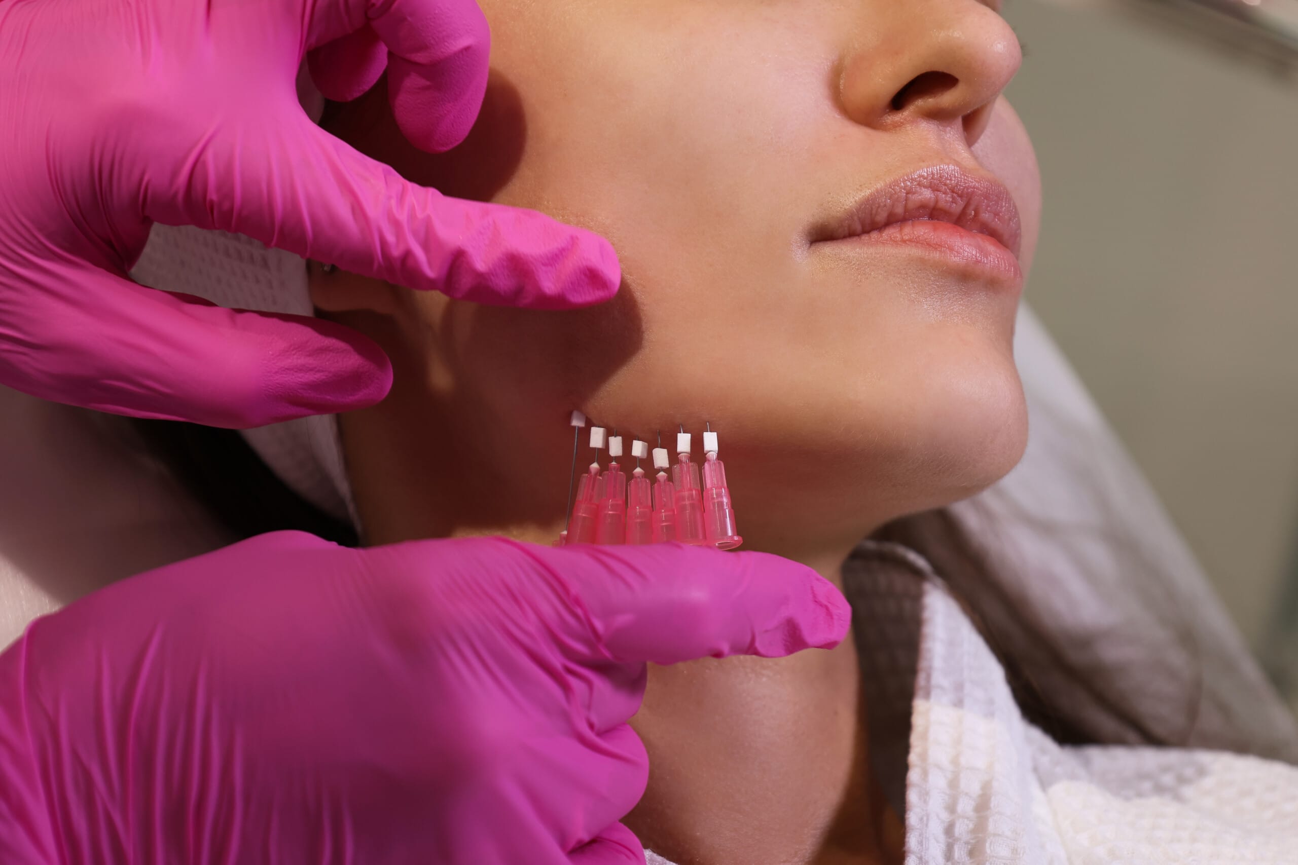 نخ مونو (نخ بدون خار – نخ کلاژن‌ساز)