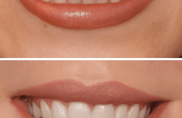 بوتاکس خنده لثه نما (گامی اسمایل)