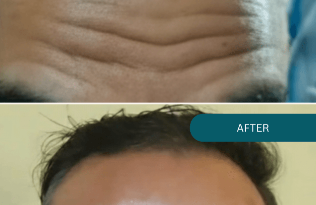 بوتاکس پیشانی