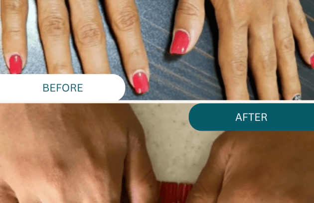 جوانسازی دست