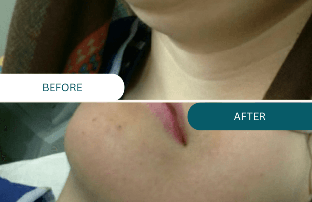 لاغری غبغب با لیزر اولترا زد