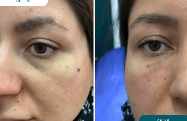 فیلر خط اشکی