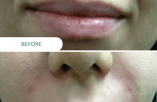 فیلر خط خنده