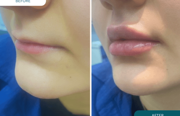 فیلر لب