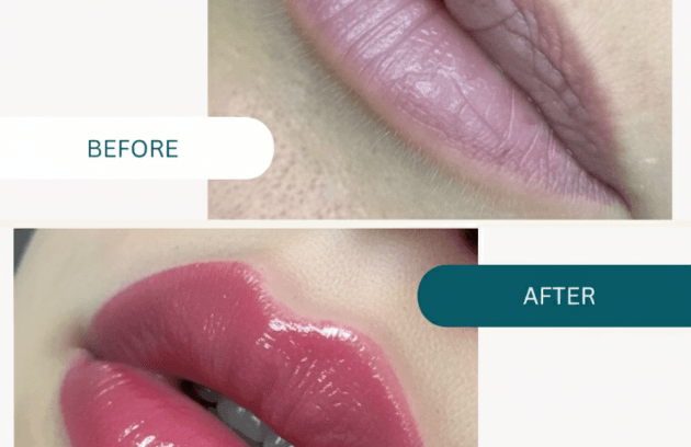 فیلر لب