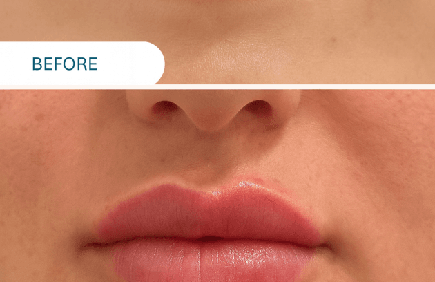 فیلر لب
