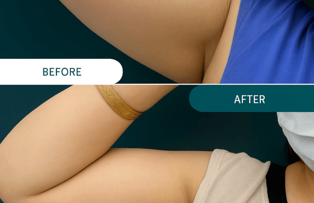 لاغری با لیزر اولترا زد