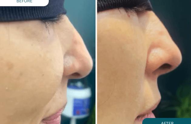 لیفت بینی با نخ