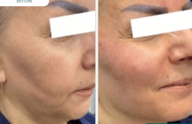 لیفت صورت با نخ