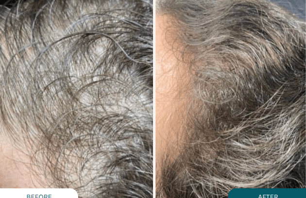 مزوتراپی مو